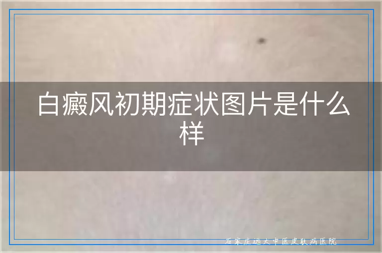 白癜风初期症状图片是什么样