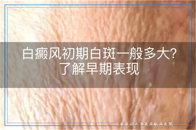 白癜风初期白斑一般多大？了解早期表现