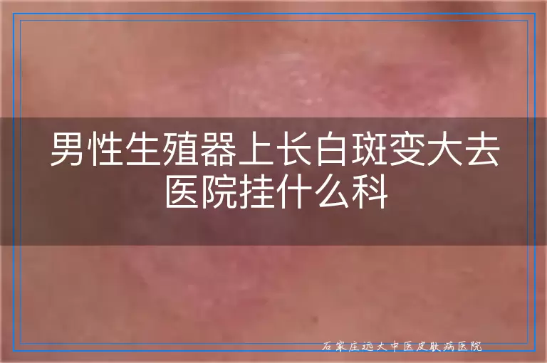 男性生殖器上长白斑变大去医院挂什么科