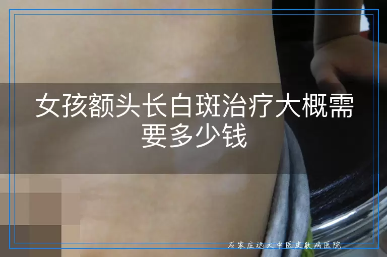 女孩额头长白斑治疗大概需要多少钱