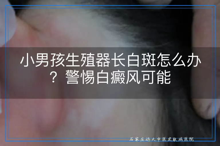 小男孩生殖器长白斑怎么办？警惕白癜风可能