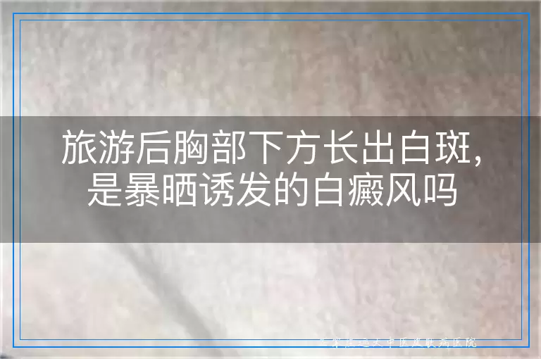 旅游后胸部下方长出白斑，是暴晒诱发的白癜风吗