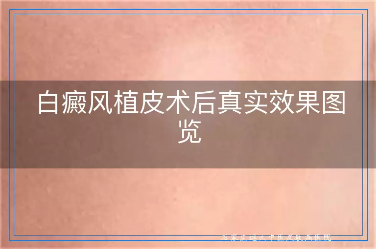 白癜风植皮术后真实效果图览