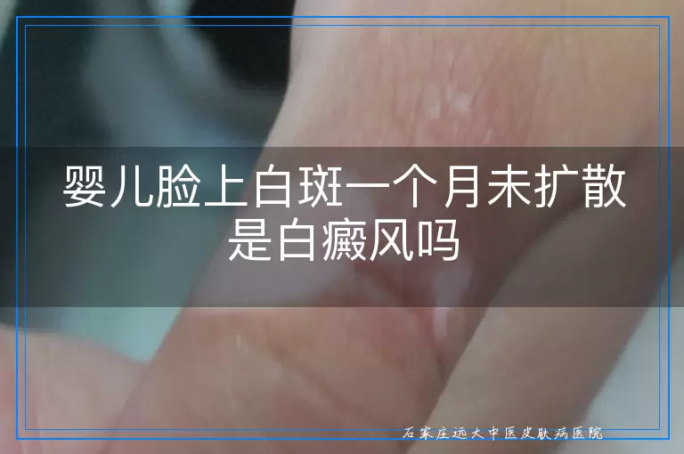 婴儿脸上白斑一个月未扩散是白癜风吗