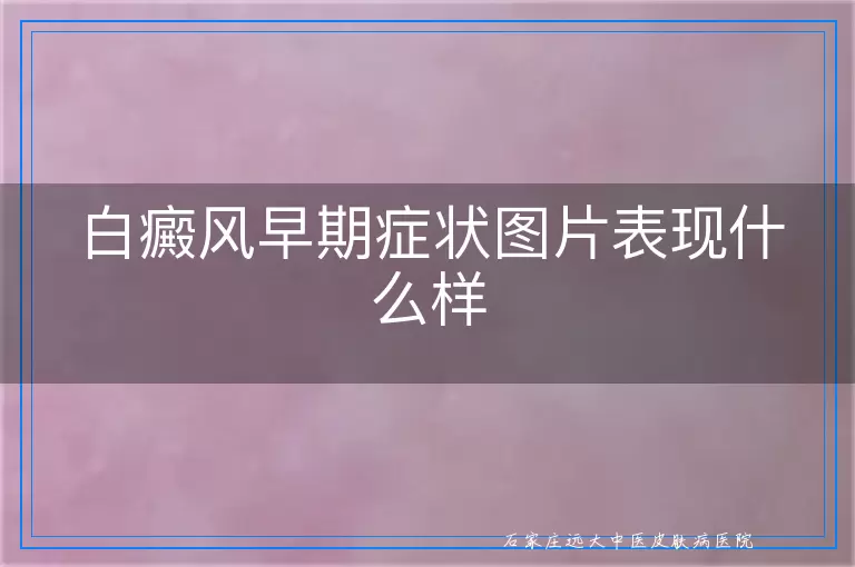 白癜风早期症状图片表现什么样