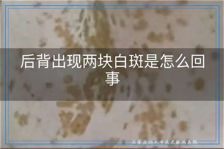 后背出现两块白斑是怎么回事