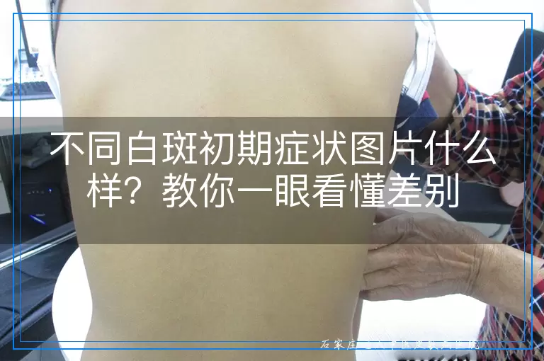 不同白斑初期症状图片什么样？教你一眼看懂差别