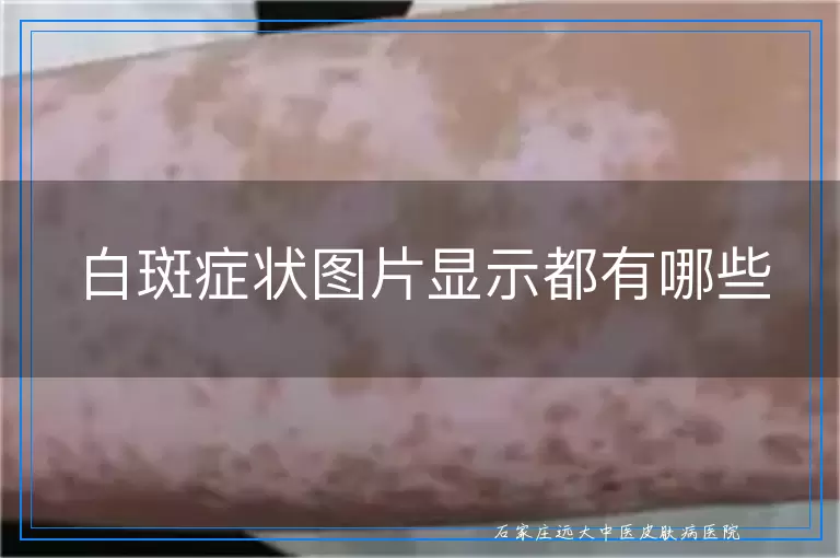 白斑症状图片显示都有哪些