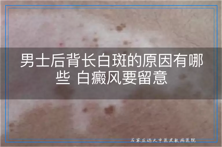 男士后背长白斑的原因有哪些 白癜风要留意