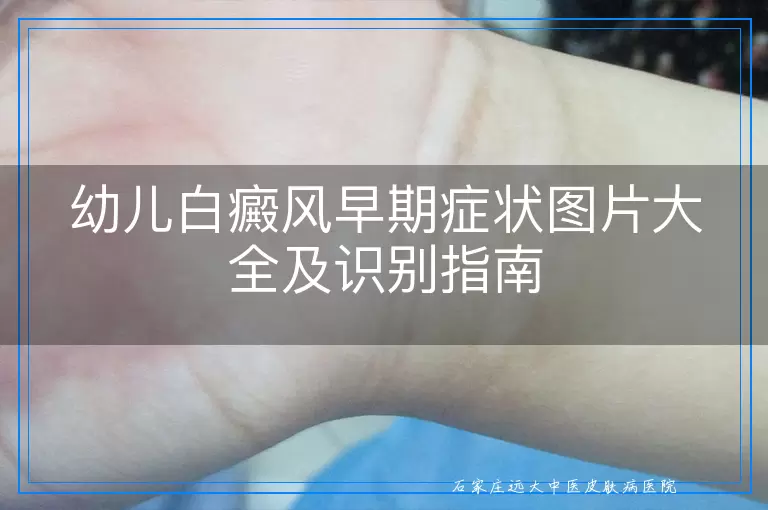 幼儿白癜风早期症状图片大全及识别指南