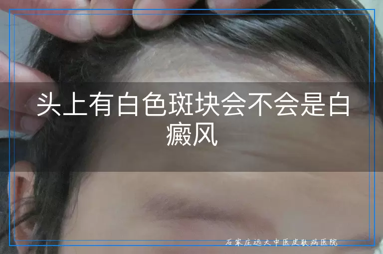 头上有白色斑块会不会是白癜风