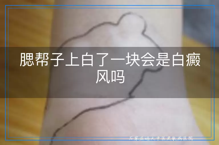 腮帮子上白了一块会是白癜风吗