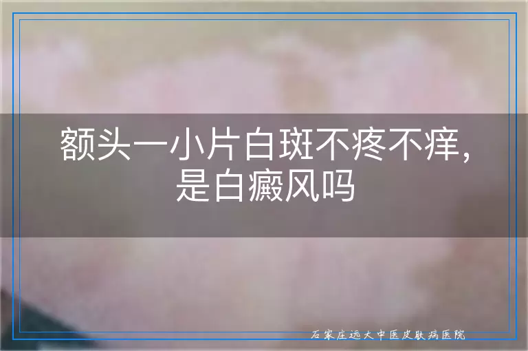 额头一小片白斑不疼不痒,是白癜风吗
