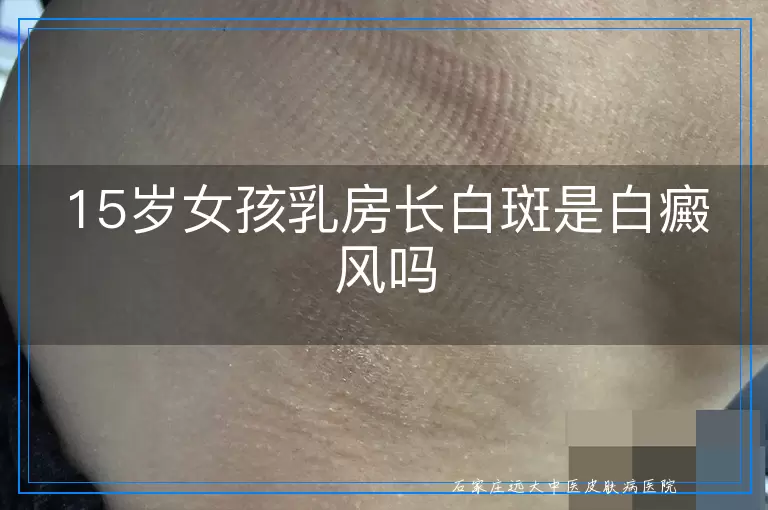 15岁女孩乳房长白斑是白癜风吗