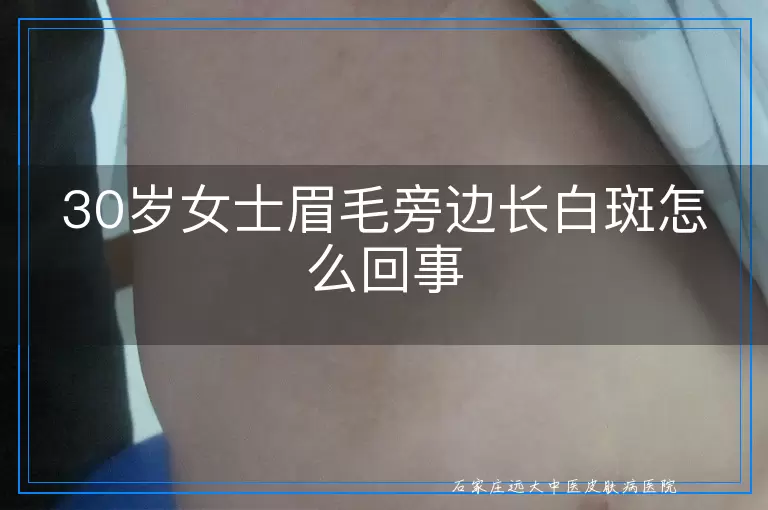30岁女士眉毛旁边长白斑怎么回事
