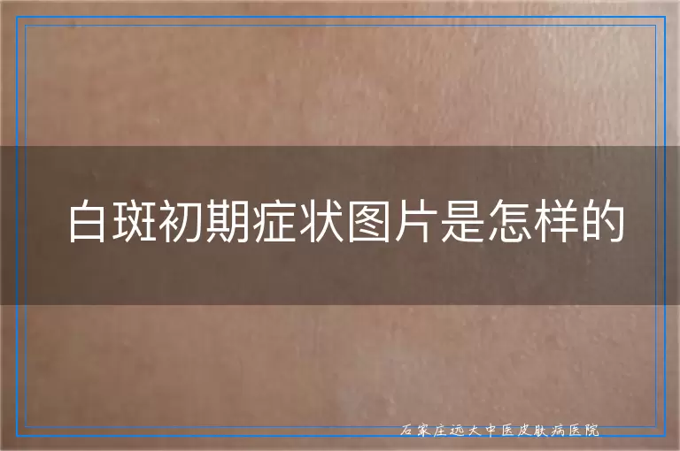 白斑初期症状图片是怎样的