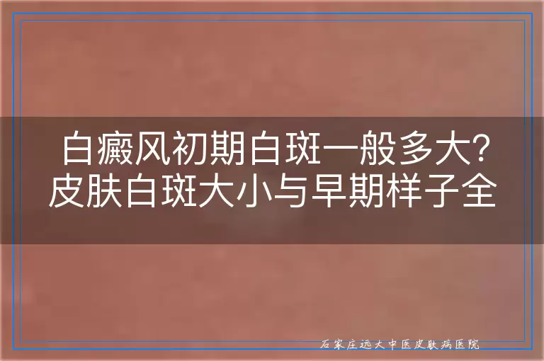 白癜风初期白斑一般多大?皮肤白斑大小与早期样子全知道