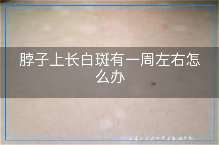 脖子上长白斑有一周左右怎么办