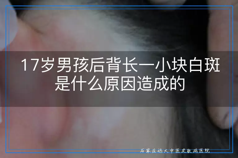 17岁男孩后背长一小块白斑是什么原因造成的