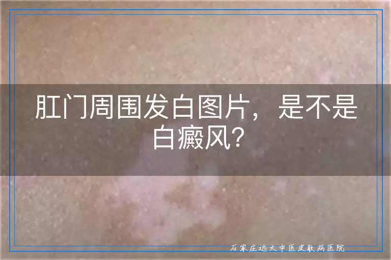 肛门周围发白图片,是不是白癜风?