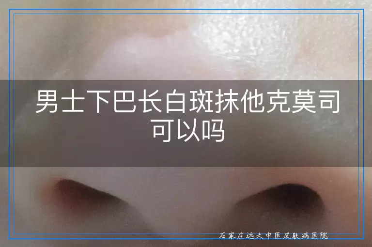 男士下巴长白斑抹他克莫司可以吗