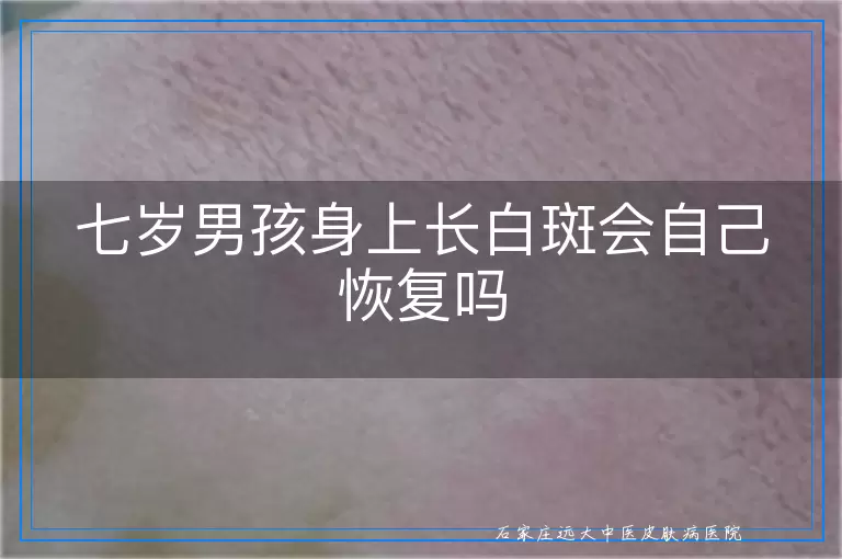 七岁男孩身上长白斑会自己恢复吗