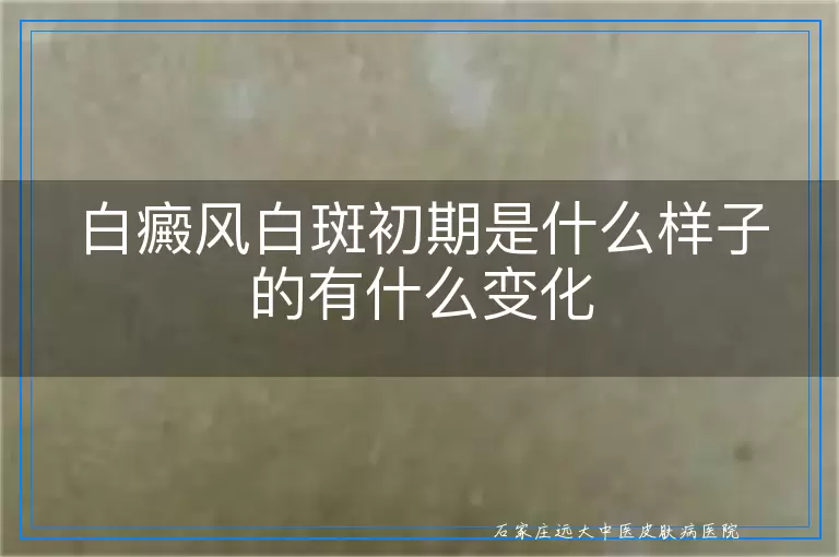 白癜风白斑初期是什么样子的有什么变化