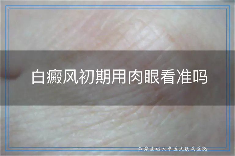 白癜风初期用肉眼看准吗