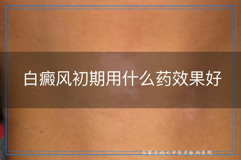 白癜风初期用什么药效果好
