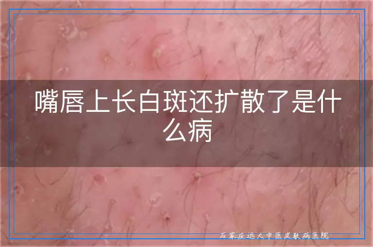 嘴唇上长白斑还扩散了是什么病