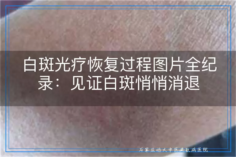 白斑光疗恢复过程图片全纪录：见证白斑悄悄消退