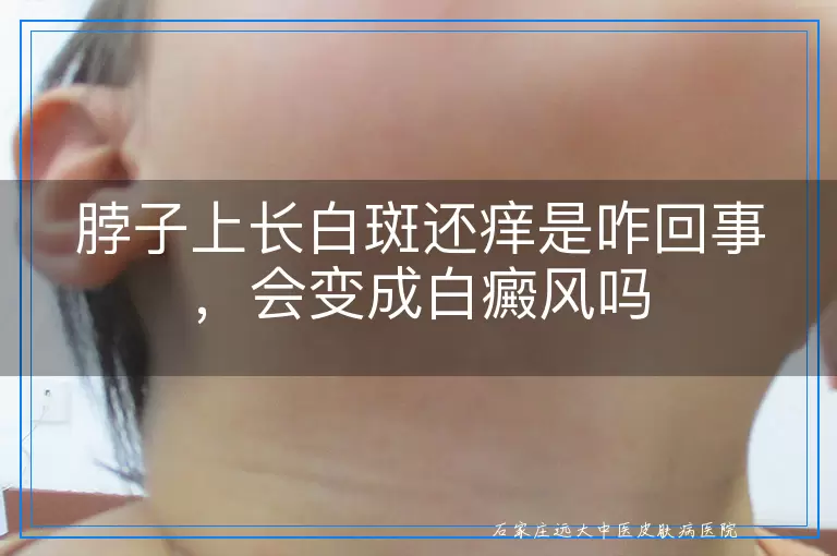 脖子上长白斑还痒是咋回事,会变成白癜风吗