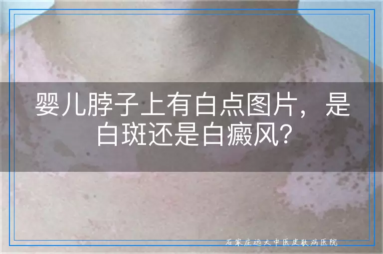 婴儿脖子上有白点图片,是白斑还是白癜风?