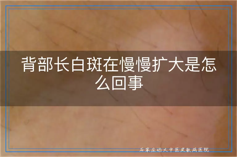 背部长白斑在慢慢扩大是怎么回事