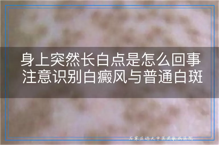 身上突然长白点是怎么回事 注意识别白癜风与普通白斑