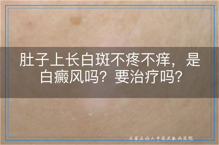 肚子上长白斑不疼不痒,是白癜风吗?要治疗吗?