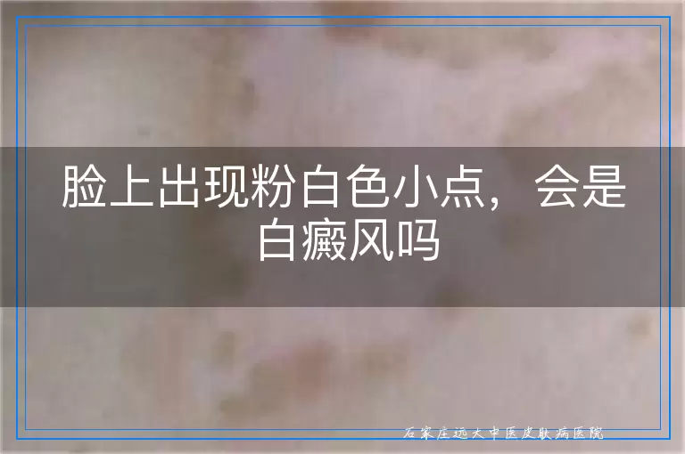 脸上出现粉白色小点，会是白癜风吗