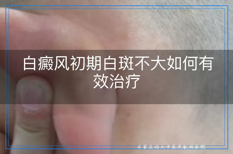 白癜风初期白斑不大如何有效治疗
