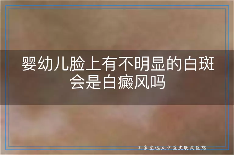 婴幼儿脸上有不明显的白斑会是白癜风吗