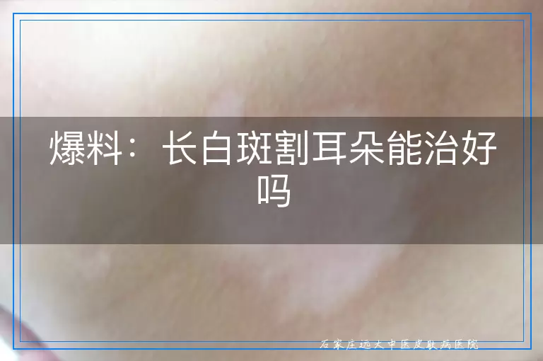 爆料：长白斑割耳朵能治好吗