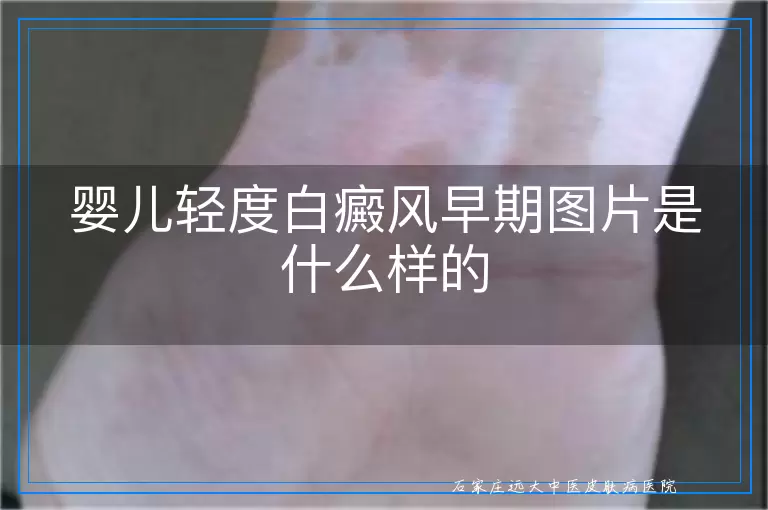 婴儿轻度白癜风早期图片是什么样的