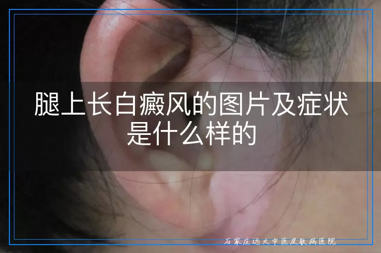 腿上长白癜风的图片及症状是什么样的