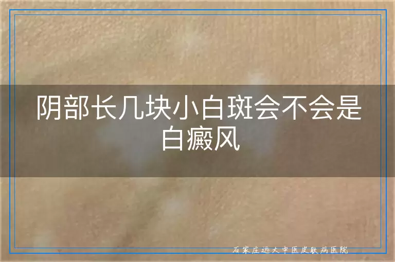 阴部长几块小白斑会不会是白癜风