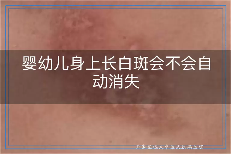婴幼儿身上长白斑会不会自动消失
