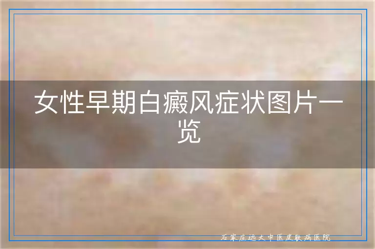 女性早期白癜风症状图片一览
