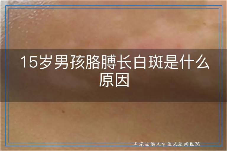 15岁男孩胳膊长白斑是什么原因