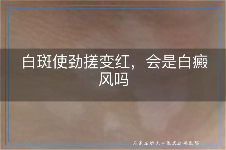 白斑使劲搓变红,会是白癜风吗