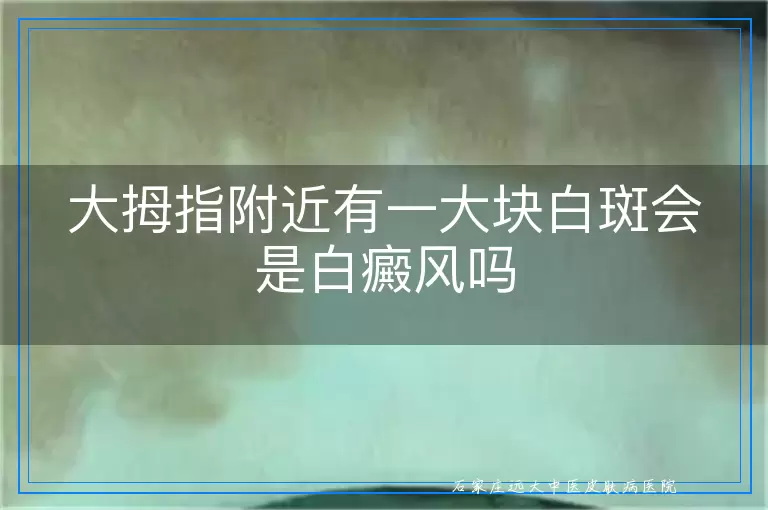 大拇指附近有一大块白斑会是白癜风吗