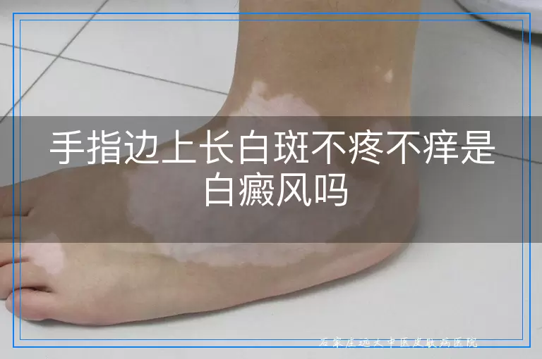 手指边上长白斑不疼不痒是白癜风吗