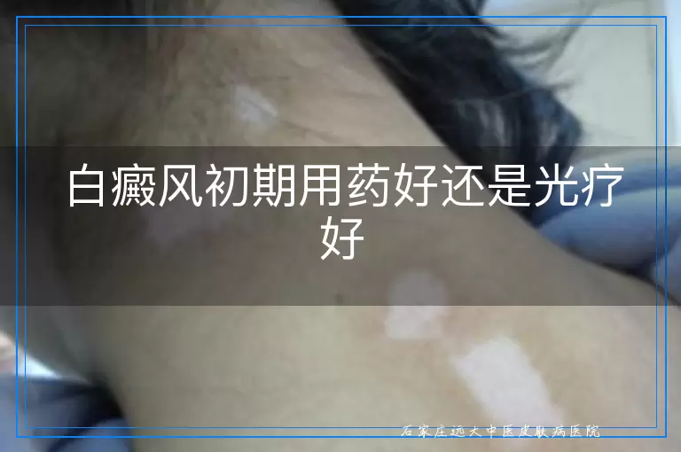 白癜风初期用药好还是光疗好